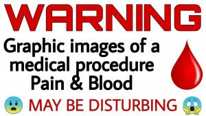 Advertencia: Imágenes gráficas de un procedimiento médico.. Dolor y sangre. Puede ser perturbador.